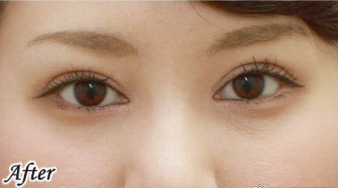 银座Miyuki美幸整形外科水谷和则双眼皮案例
