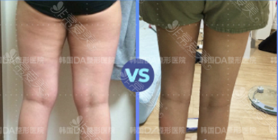 韩国DA整形腿部吸脂手术前后图