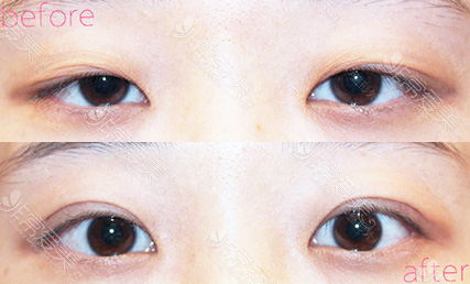 韩国BIO整形外科上眼皮下垂案例