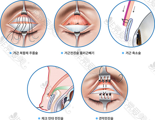 韩国BIO整形外科上眼皮下垂手术过程