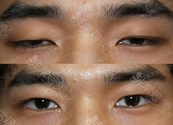 韩国BIO整形外科男性上眼皮下垂矫正效果
