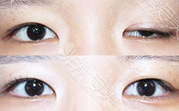 韩国BIO整形外科单眼上眼皮下垂