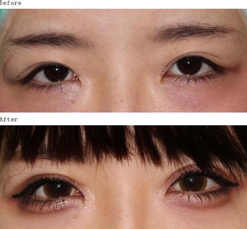 日本汤田眼科美容医院眼整形案例图