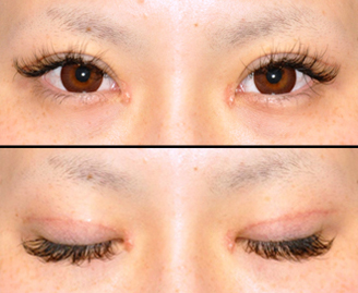 日本加藤美容整形医院双眼皮修复术后1个月进行开眼角