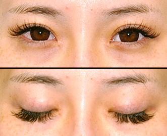 日本加藤美容整形医院双眼皮术后5个月效果