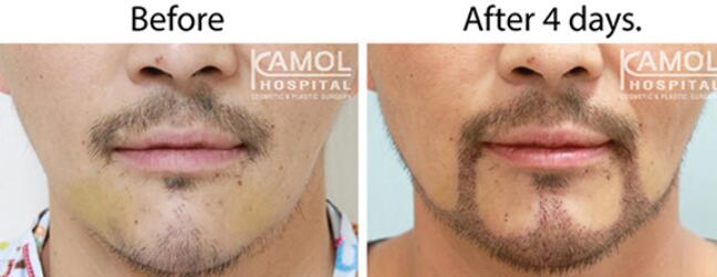 泰国KAMOL咖蒙整形胡须移植案例图