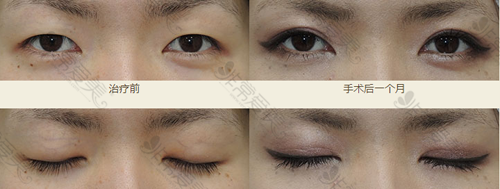 日本银座S美容形成外科医院双眼皮手术