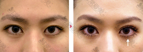 日本真崎（MASAKI） 美容外科医院双眼皮手术 