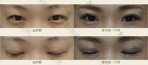 日本银座S美容形成医院双眼皮手术前后