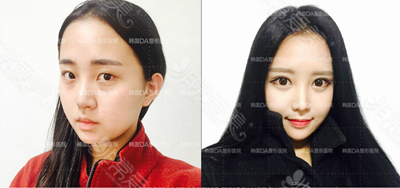 韩国DA整形双眼皮手术前后对比