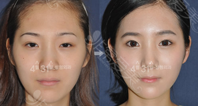韩国4月31日医院双眼皮整形