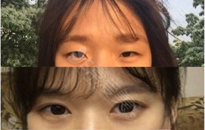 韩国碧夏整形双眼皮手术图