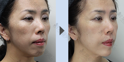 日本Takami美容整形外科玻尿酸全脸注射案例对比