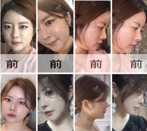 韩国皮肤科artline超声波脸部提升有用吗