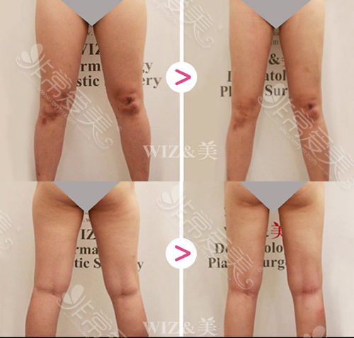 韩国WIZ&美大腿吸脂对比图