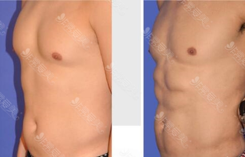 泰国Naravee Clinic医院抽脂抽出六块腹肌图片
