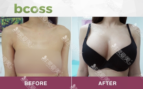 泰国BCOSSClinic整形外科胸部整形对比效果图