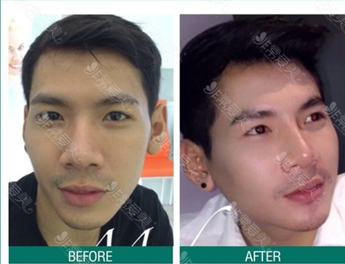 泰国BCOSSClinic整形外科男士鼻整形案例