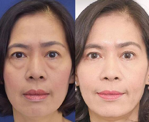 泰国W整形外科眼袋整形前后照片