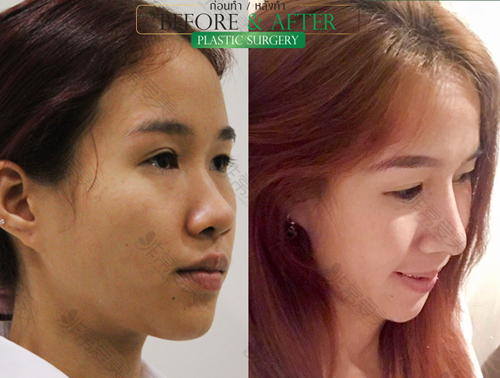泰国Lelux整形外科鼻整形前后对比