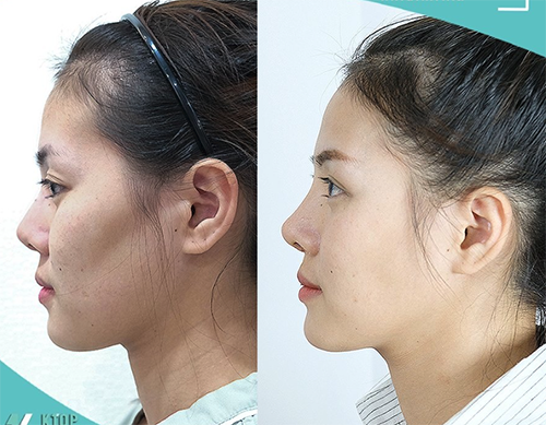 女性鼻部整形手术对比案例