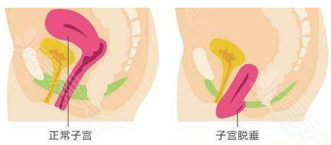 宫颈口下垂图片图片
