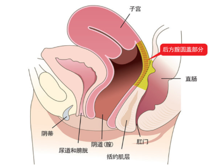 韩国好手艺后方膣圆盖手术方法怎么样