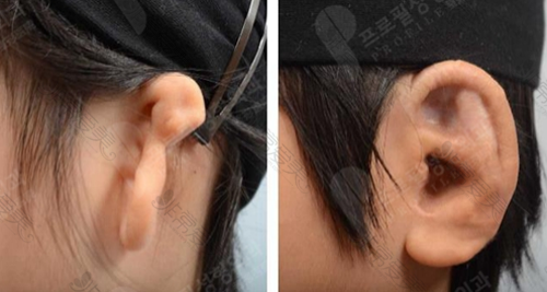 普罗菲耳医院耳畸形矫正前后对比