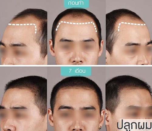 泰国杰作医院毛发移植前后对比案例