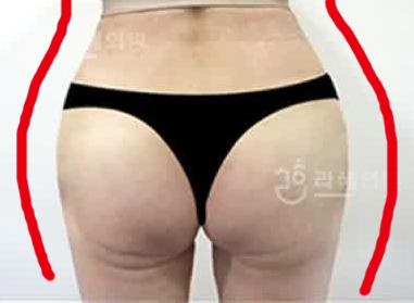 韩国RAHAE整形外科自体脂肪丰臀后图