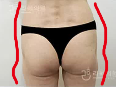 韩国RAHAE整形外科自体脂肪丰臀前图