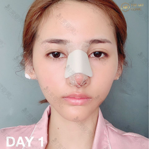用我去泰国整形亲身经历告诉你泰国隆鼻技术怎么样！