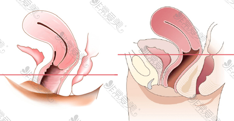 下垂子宫与未下垂子宫对比图