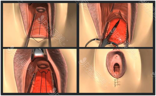 韩国好手艺私密整形医院阴道紧缩术过程展示图