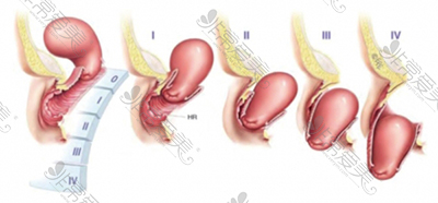 子宫下垂阶段图