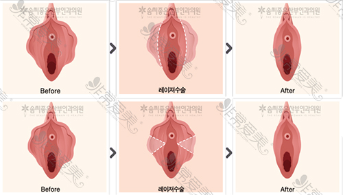 韩国好手艺小阴唇整形方案图