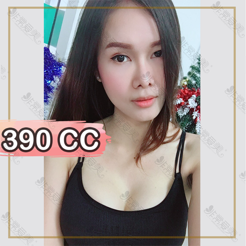 泰国yanhee隆胸390CC图片