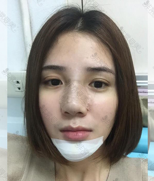 泰国yanhee医院隆鼻手术恢复期