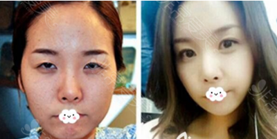 双眼皮修复毁的更严重了！韩国眼部7层缝合哪位医生可以做