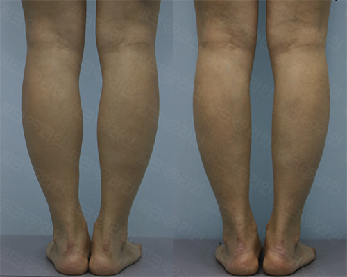 韩国pinkline皮肤科小腿塑形手术对比日记