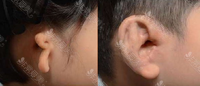 韩国普罗菲耳Profile整形医院外耳再造图