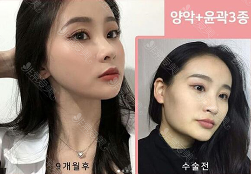 韩国齐娥正颌手术后脸型改变图