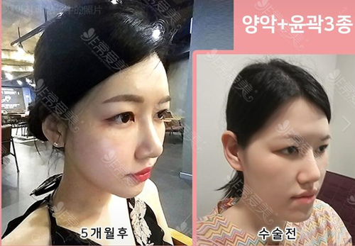 韩国姜永浩颌面轮廓手术