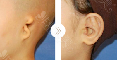 韩国普罗菲耳Profile整形医院耳廓重建