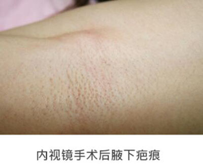 韩国三星YUBANG整形外科隆胸术后疤痕