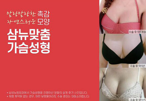 韩国三星YUBANG整形外科隆胸案例