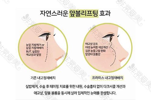 韩国Promise整形眼底脂肪重置手术优势