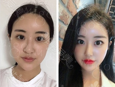 韩国MIGO整形外科隆鼻