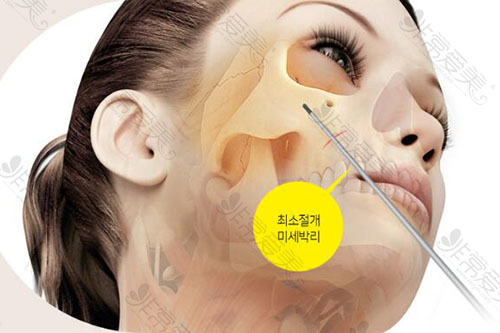 韩国脸本脸骨整形外科轮廓整形优势