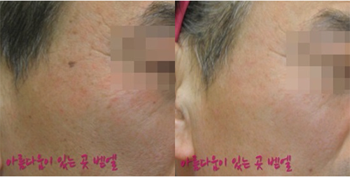 韩国bethel皮肤科医院面部祛斑手术案例图